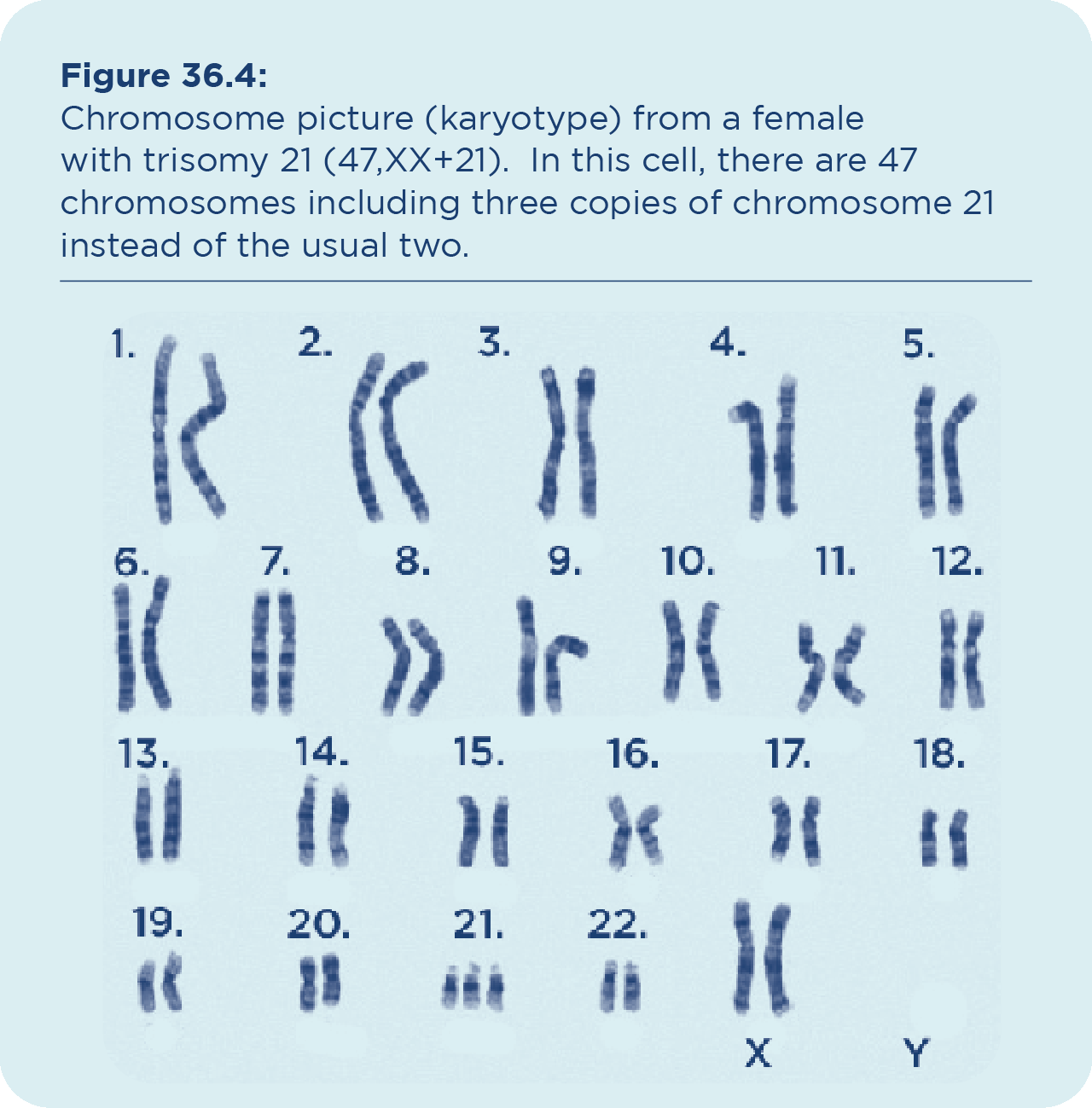 Trisomy 21 Down Syndrome