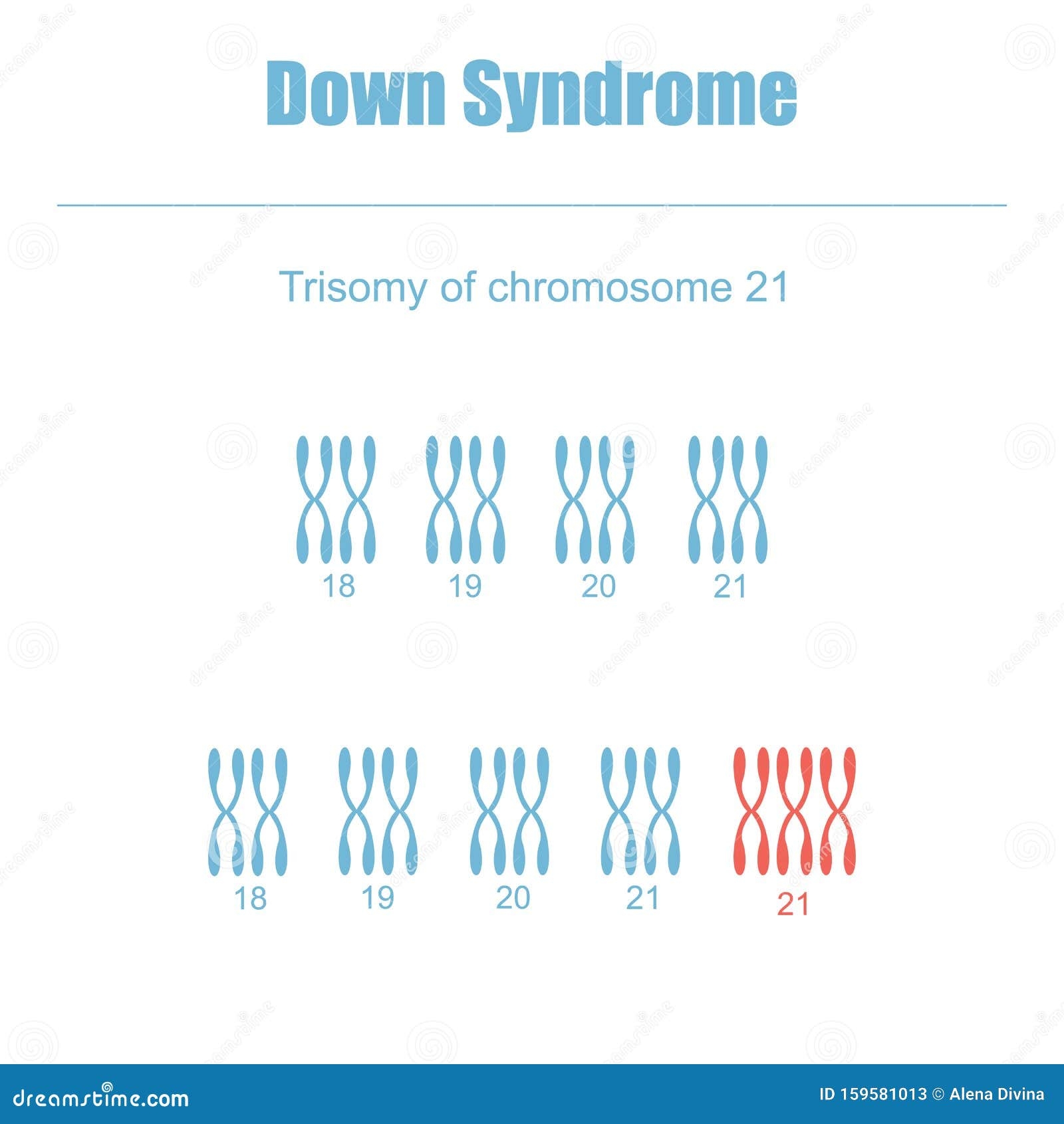 Trisomy Of Chromosome 21 Stock Vector Illustration Of Number 159581013