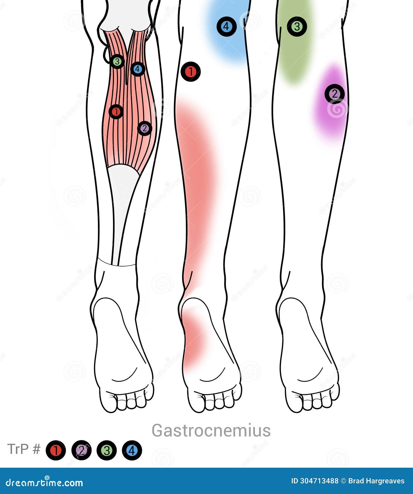 Gastocnemius Calf Muscle Myofascial Trigger Points Stock Illustration Illustration Of Anatomy Sole 304713488
